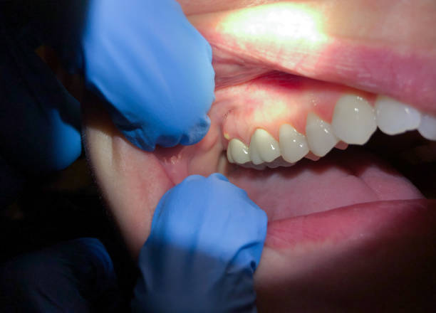 Best Teeth Whitening  in Johnson City, TX